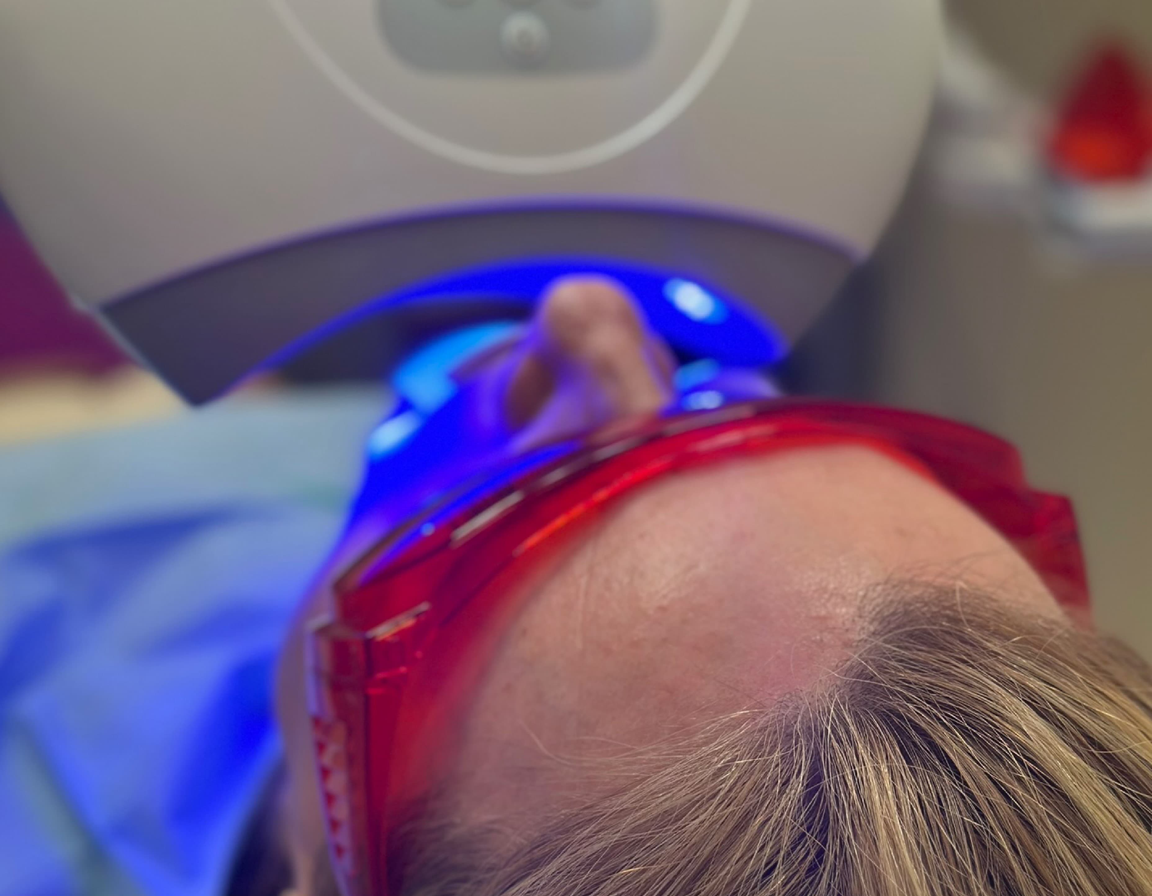 Blanqueamiento dental: tratamiento estético bajo supervisión del dentista