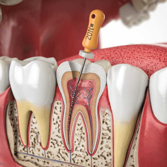 Endodoncia