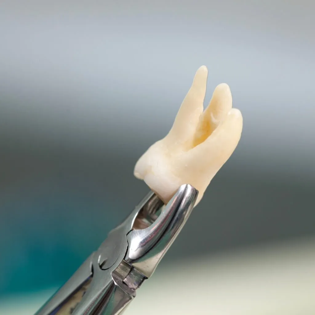 Extracción dental: cuidados después del tratamiento