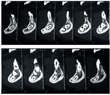 Figura 3 - CBCT cortes tomográficos