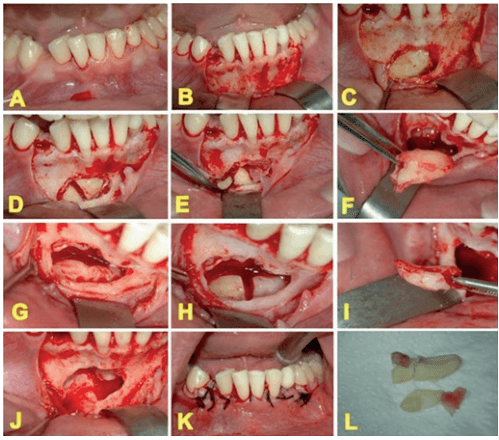 Figura 4 - Secuencia intraoperatoria
