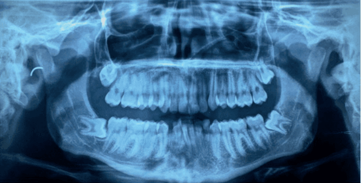 Figura 6 - Imagen intraoral 6 meses después