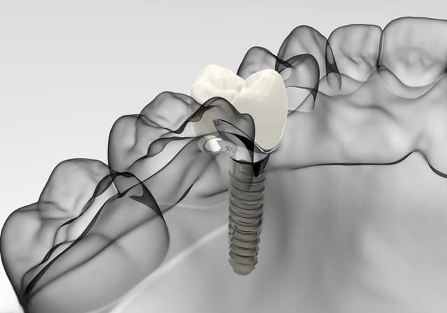 Implantes dentales